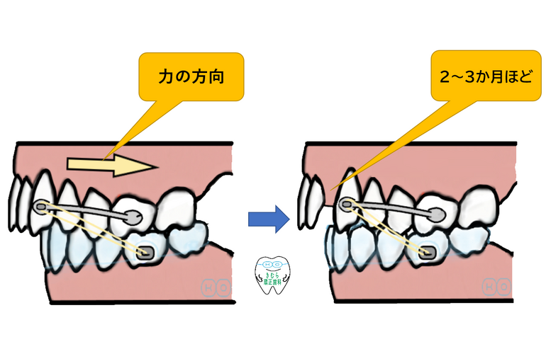 経過1